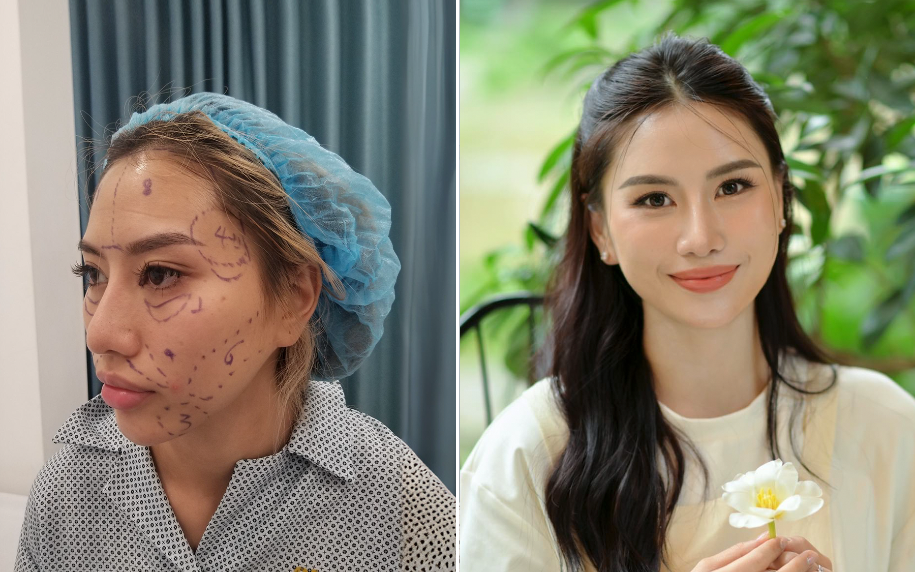 Đột quỵ sau cấy mỡ tự thân, nữ bệnh nhân phải tái tạo hộp sọ- Ảnh 2.