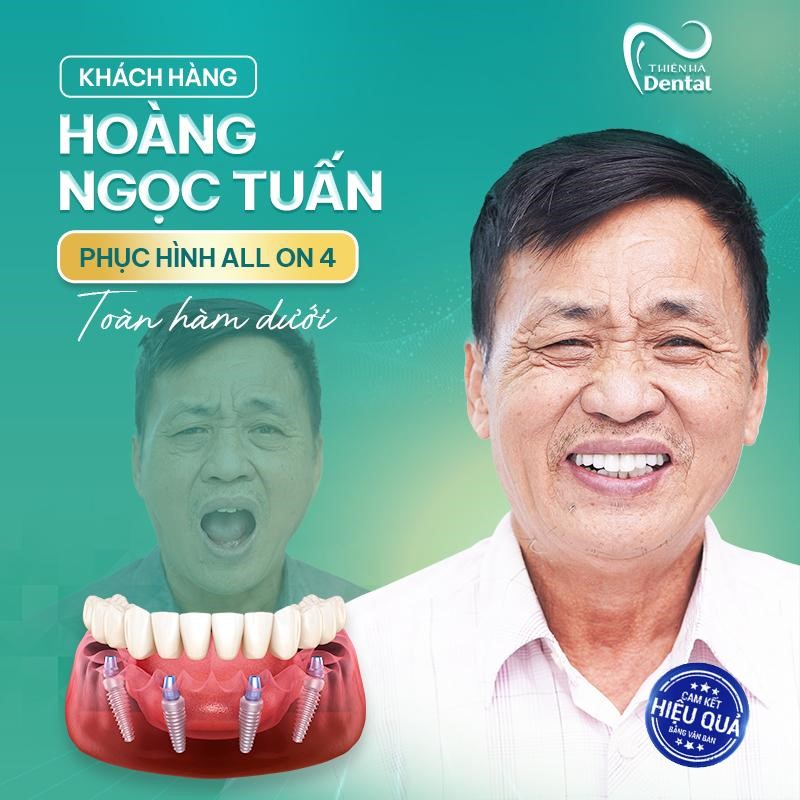 Đánh giá dịch vụ trồng răng implant