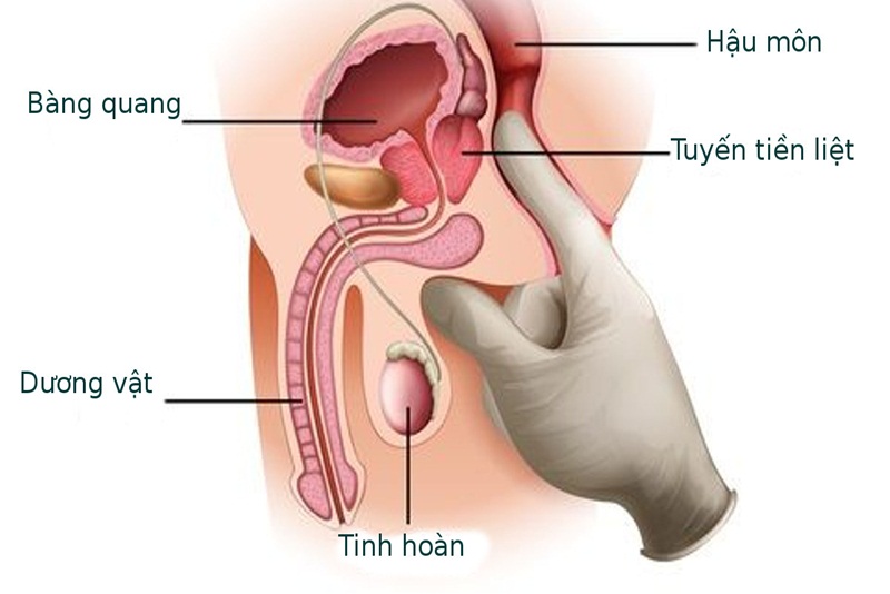 Câu hỏi thường gặp liên quan đến ung thư tuyến tiền liệt- Ảnh 1.