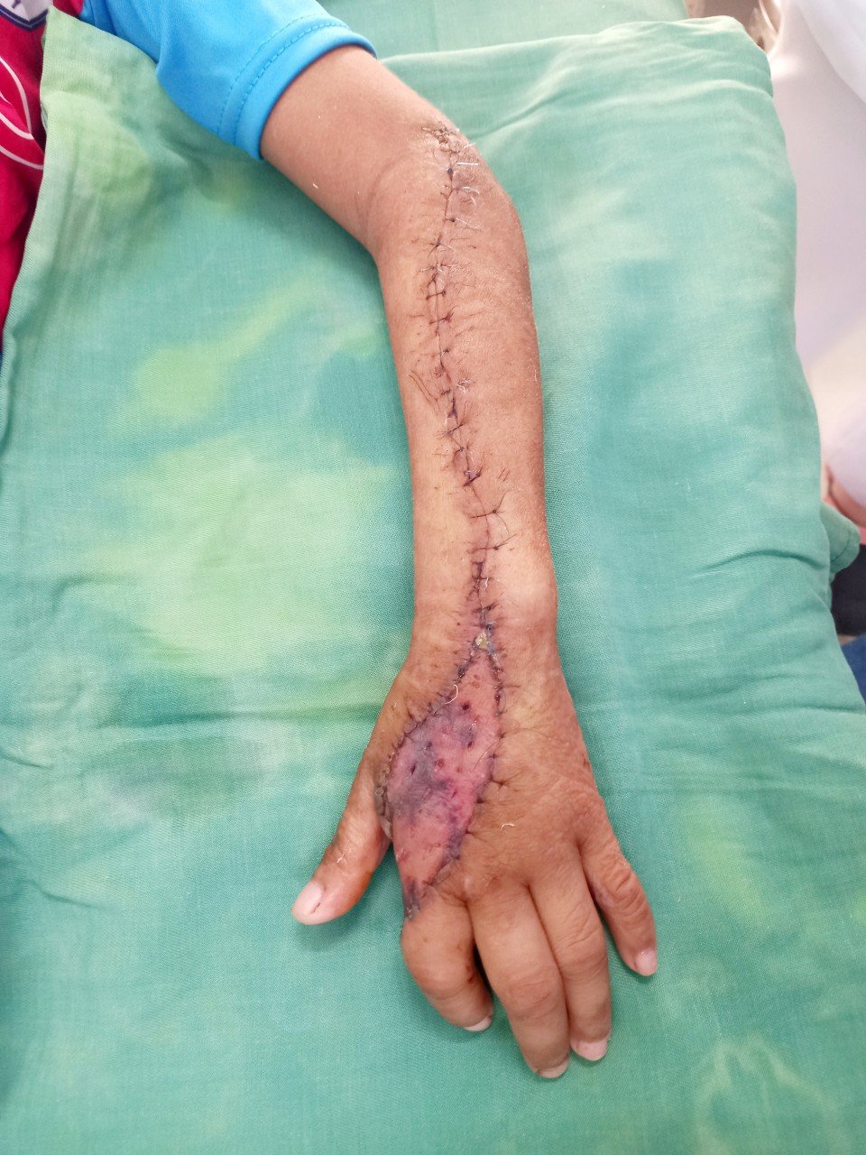 Phẫu thuật bảo tồn bàn tay bé trai 8 tuổi bị hoại tử nghi do rắn cắn - Ảnh 2.