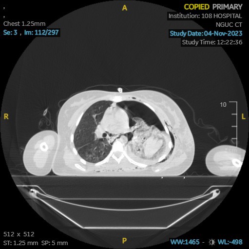 Bác sĩ Bệnh viện 108 cấp cứu thành công cho nữ sinh 17 tuổi bị đứt phế quản do tai nạn trên đường đi học về- Ảnh 2.