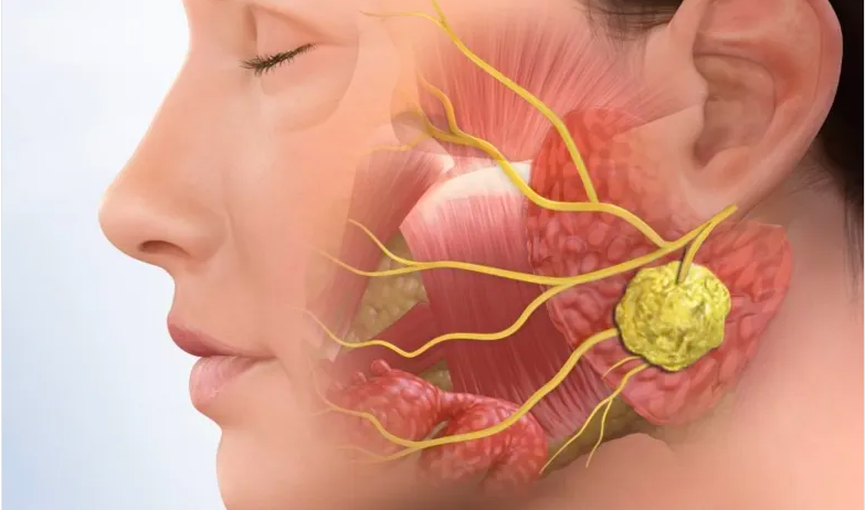 Quản lý bệnh phổi ở người mắc hội chứng Sjögren