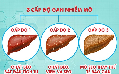 Cách cải thiện gan nhiễm mỡ độ 1 không dùng thuốc - Ảnh 3.