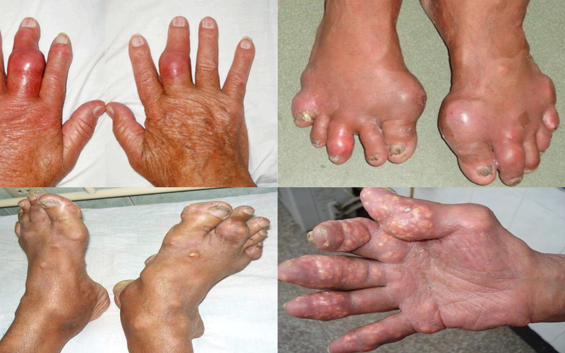 Bệnh gout và những biến chứng nguy hiểm mà nhiều người chưa biết