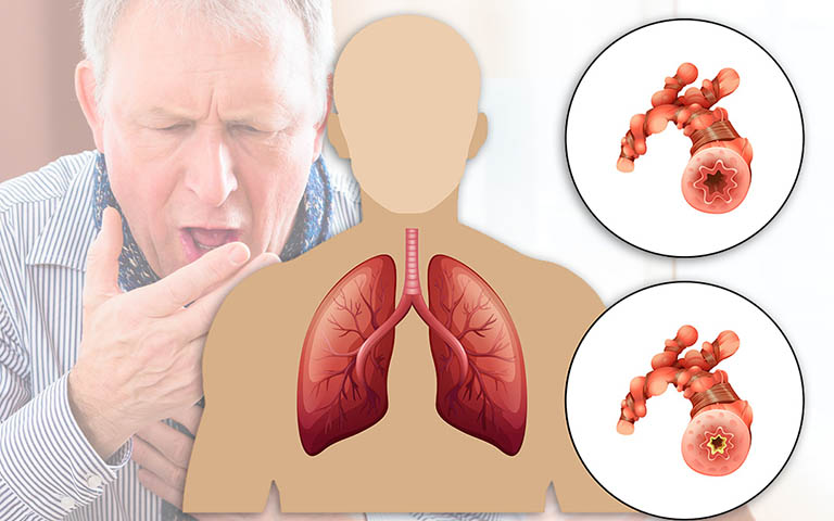 Những bệnh viêm đường hô hấp dưới thường gặp