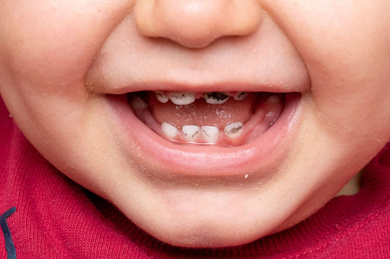 Những việc cha mẹ cần làm khi trẻ bị sâu răng