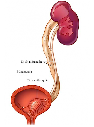 Đau tức bụng, vùng thắt lưng, tiểu khó,… thận trọng với bệnh lý thận - niệu quản đôi - Ảnh 1.