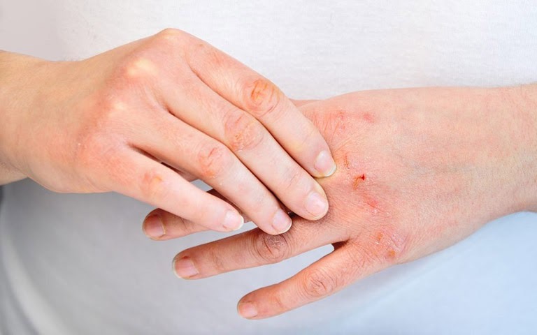 Biểu hiện của viêm da cơ địa ở từng lứa tuổi