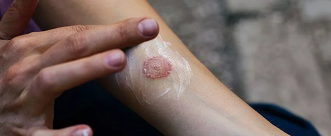 Nấm da bùng phát vì thời tiết nồm ẩm: Điều trị và phòng ngừa - Ảnh 5.