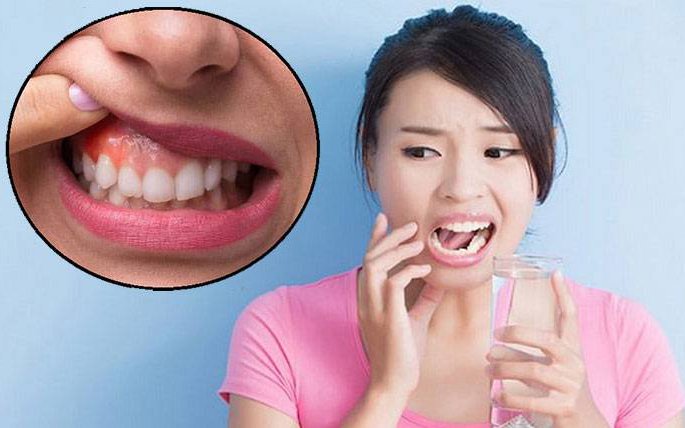 Viêm quanh răng: Nguyên nhân, biểu hiện và điều trị