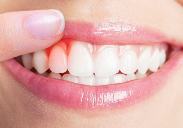 Viêm quanh răng: Nguyên nhân, biểu hiện và điều trị - Ảnh 2.