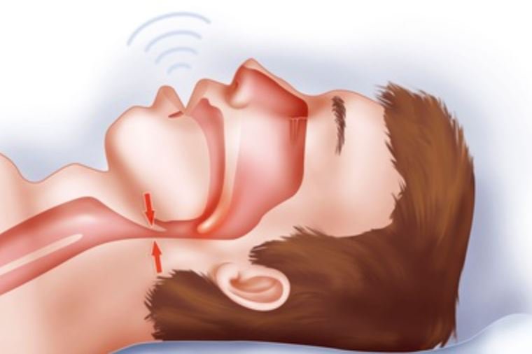 Ngủ ngáy và hội chứng OSAS