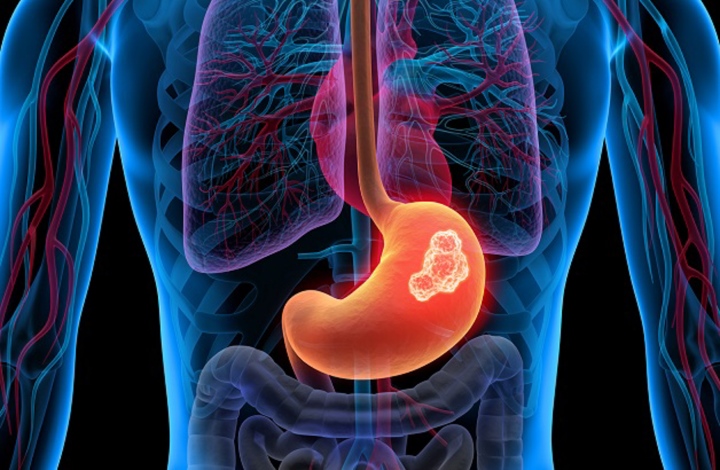 5 biến chứng thường gặp của ung thư dạ dày cần biết- Ảnh 1. 5 biến chứng thường gặp của ung thư dạ dày cần biết- Ảnh 1.