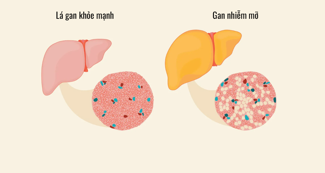 Những biểu hiện gan nhiễm mỡ dễ bị bỏ qua vào ban đêm