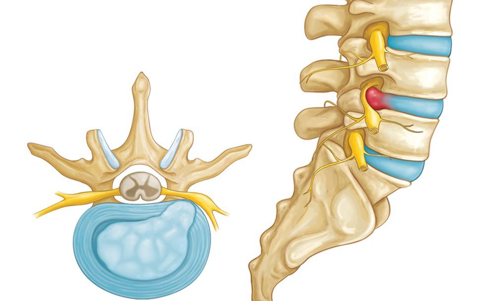 Biểu hiện của thoát vị đĩa đệm, cách điều trị hiệu quả