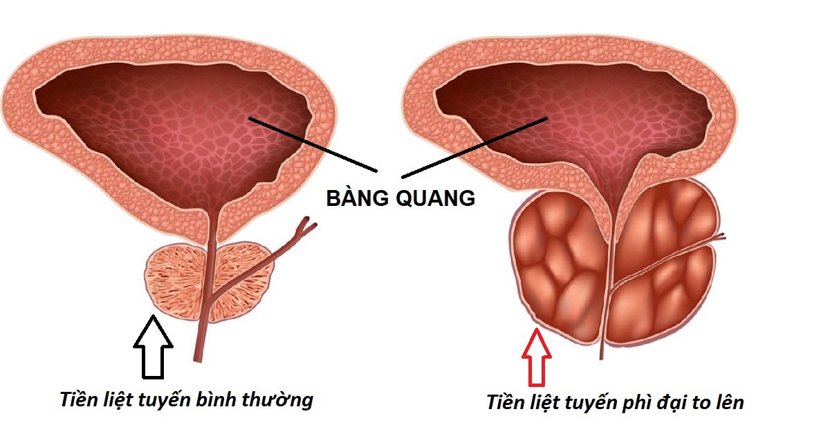 U phì đại tiền liệt tuyến nguyên nhân, hậu quả và phương hướng điều trị