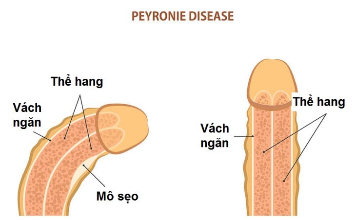 Cong dương vật - khi nào phải phẫu thuật? - Ảnh 1.