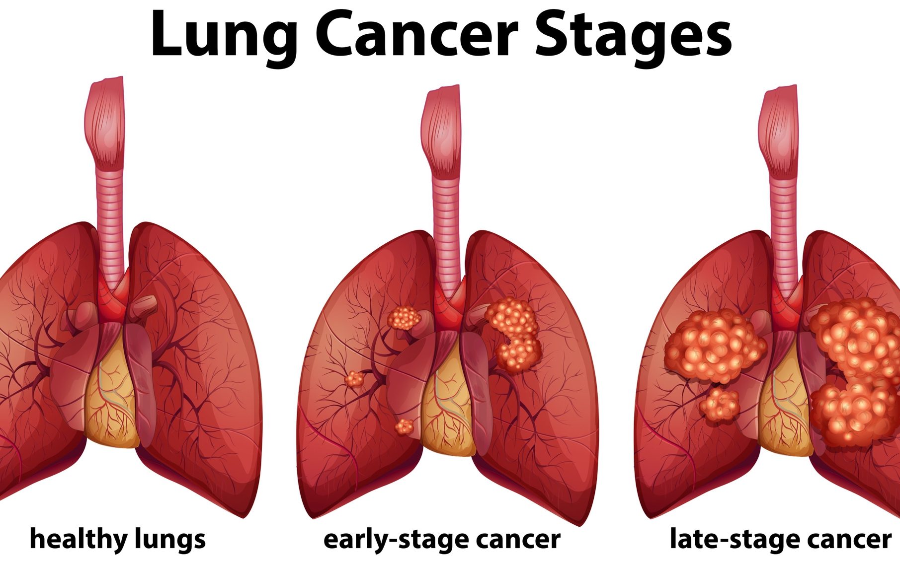 Các giai đoạn sớm của ung thư phổi cần biết