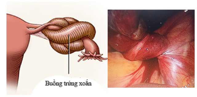 Phụ nữ mang thai cần làm gì nếu có u buồng trứng? - Ảnh 2.