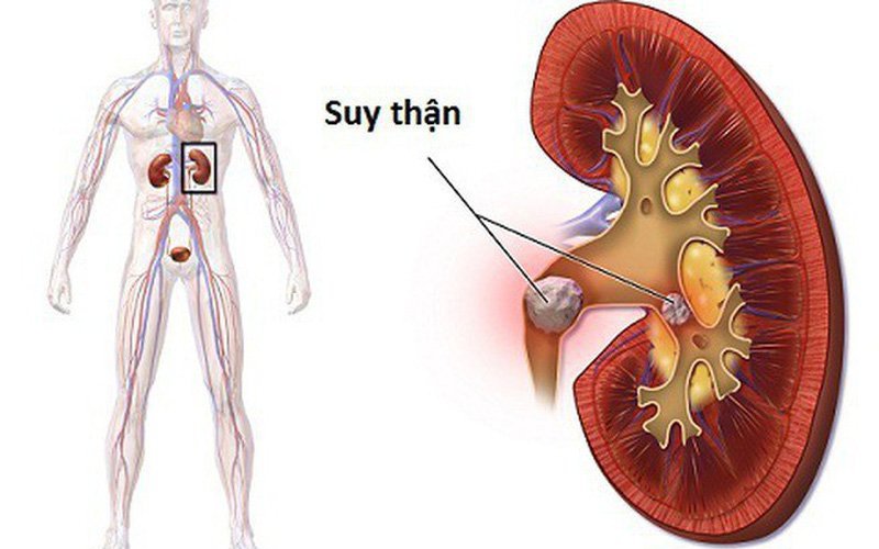 Những thực phẩm cần hạn chế ở người bệnh suy thận giai đoạn cuối