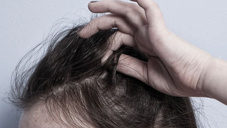Thuốc trị bệnh Alzheimer có thể làm giảm chứng rối loạn giật tóc - Ảnh 2.