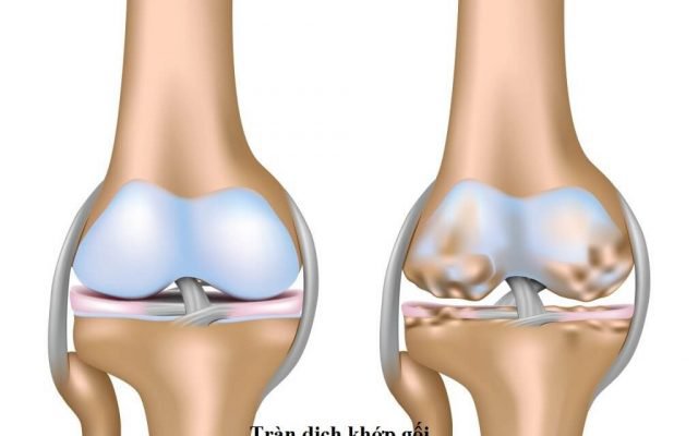 Vì sao tràn dịch khớp gối hay bị tái lại và cách hạn chế