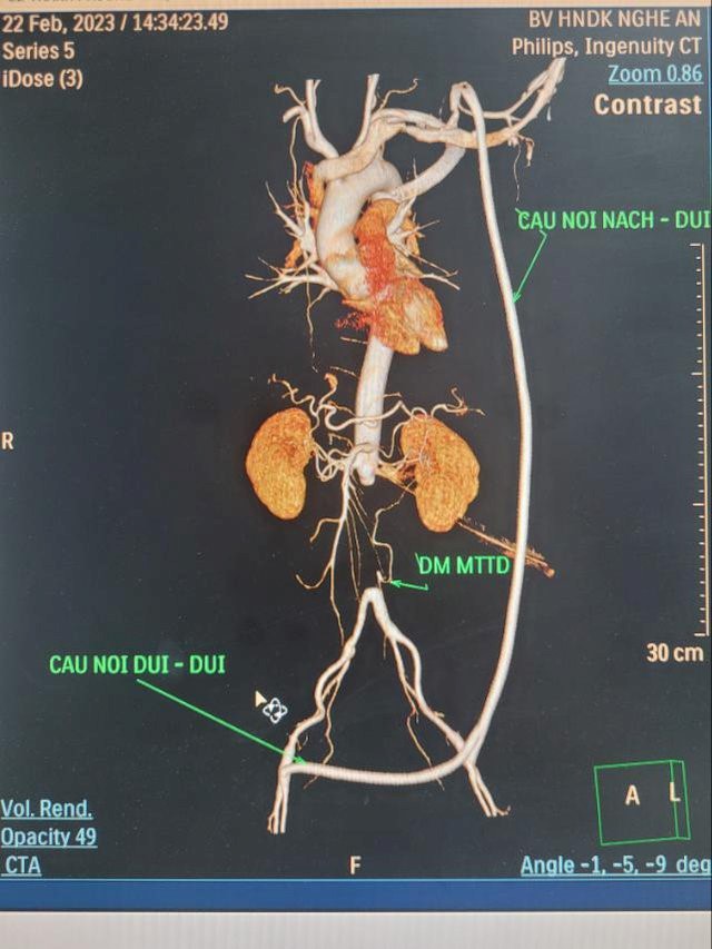 Cứu sống bệnh nhân rò động mạch chủ - đường tiêu hoá tiên phát hiếm gặp - Ảnh 2.