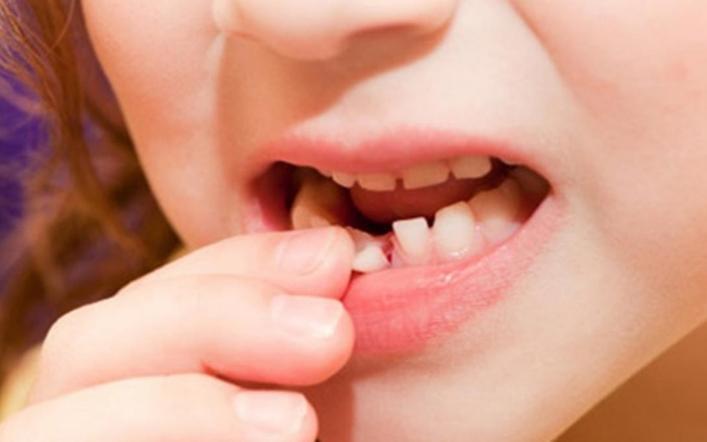 Thay răng sữa ở trẻ và cách chăm sóc đúng