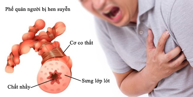 Mắc chồng chéo hen COPD, chữa thế nào? - Ảnh 1.