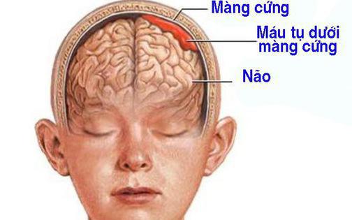 Bị ngã sau 2 tháng mới phát hiện bị tụ máu dưới màng cứng, bệnh nhân phải phẫu thuật khẩn cấp