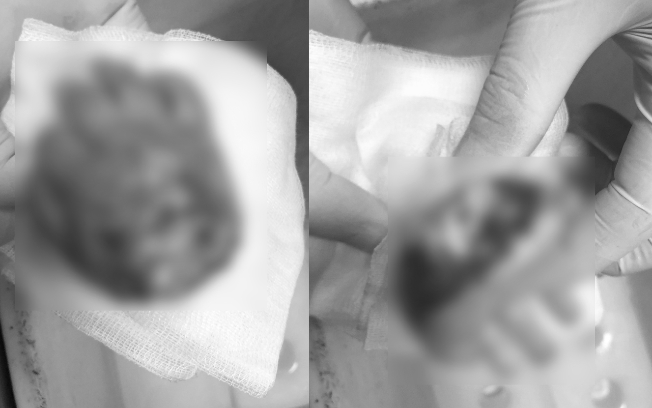 Cứu bàn tay gần lìa của nam công nhân bị máy cưa gỗ cắt- Ảnh 3. Máy dập nắp cốc nhựa cứa đứt lìa bàn tay bé trai