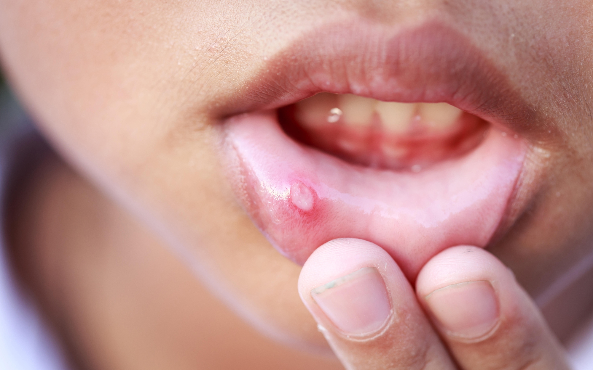 6 sai lầm khi trị nhiệt miệng khiến bệnh lâu khỏi