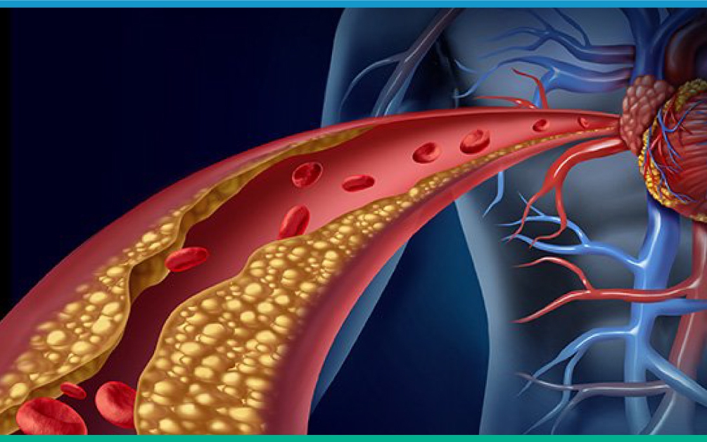 Bệnh mạch vành có thể dẫn đến các cơn nhồi máu cơ tim nguy hiểm