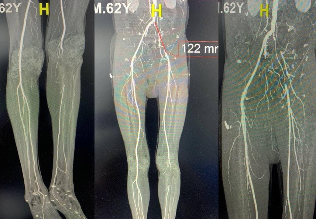 Người cao tuổi đau, tê chân kéo dài… cảnh giác tắc động mạch chi nguy hiểm- Ảnh 1. Người cao tuổi đau, tê chân kéo dài… cảnh giác tắc động mạch chi nguy hiểm- Ảnh 1.