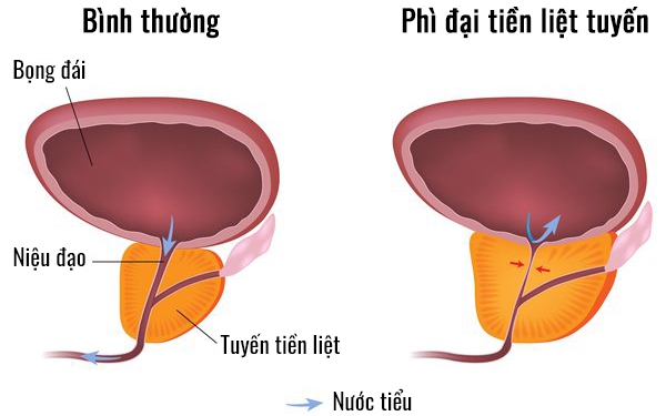 Phì đại tiền liệt tuyến có chữa được không?