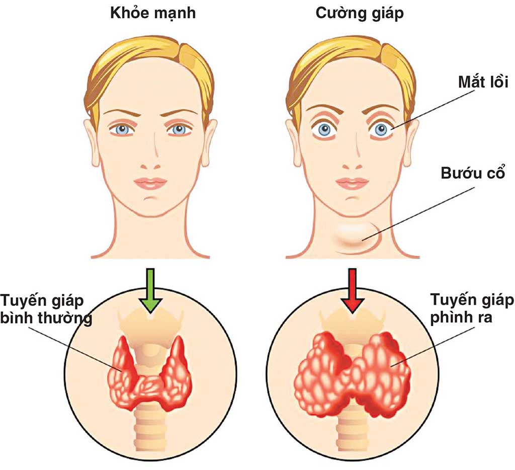 4. Chẩn Đoán U Tuyến Giáp Lành Tính