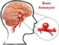 Hiểu biết về bệnh lý phình máu não cho đúng - Ảnh 1.