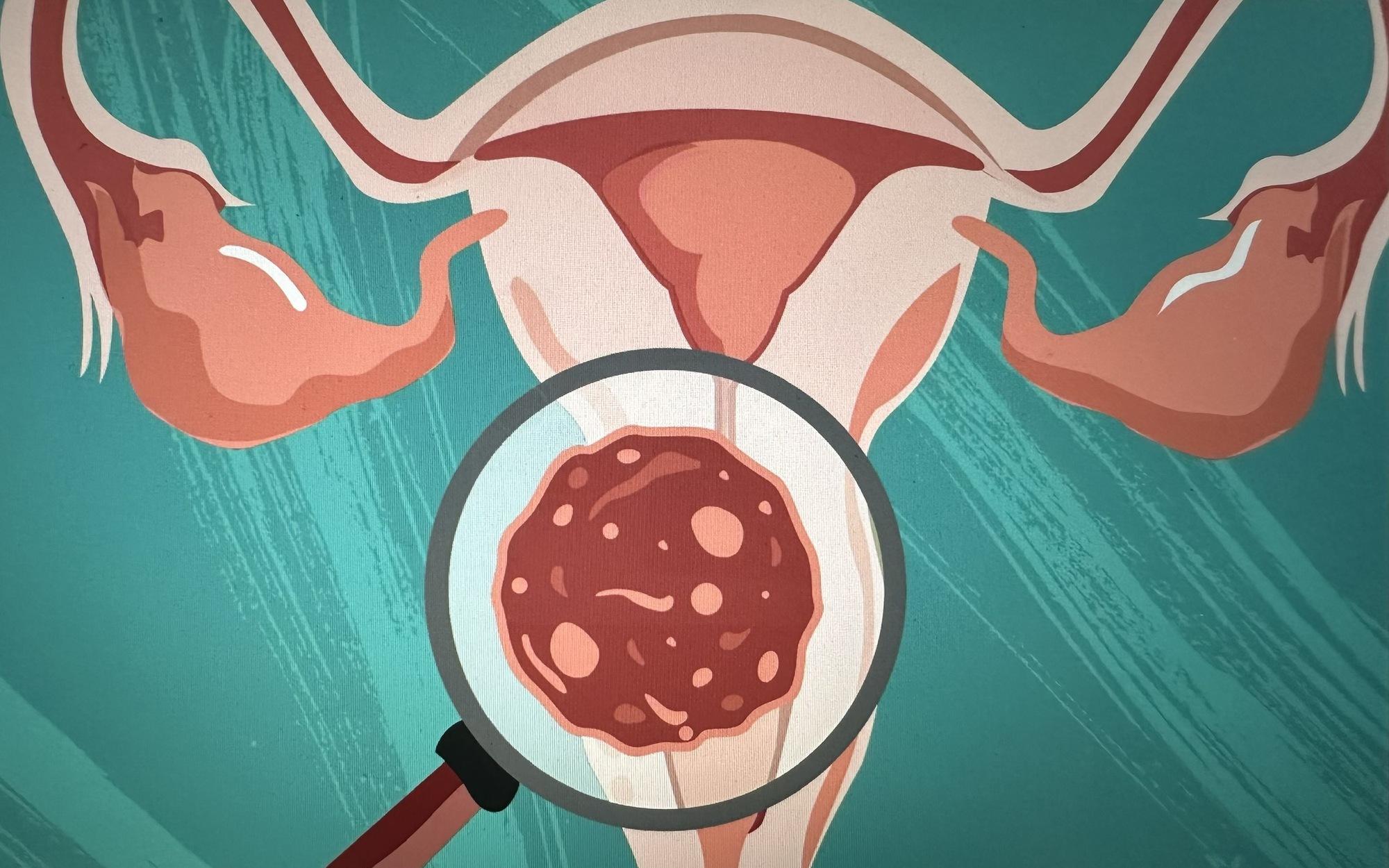 Ung thư cổ tử cung có chữa được không?