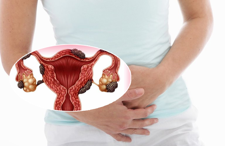 Lạc nội mạc trong cơ tử cung có thể khỏi mà không cần phẫu thuật?