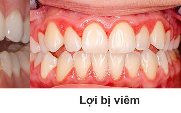 Viêm lợi: Nguyên nhân, biểu hiện và điều trị