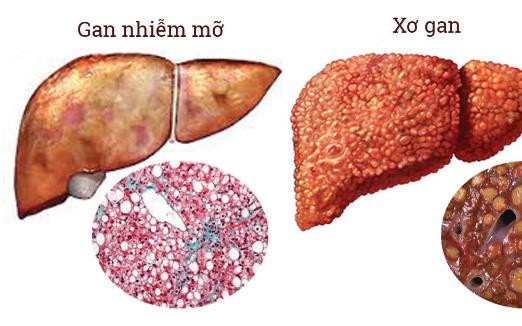 Hoàng kỳ - vị thuốc hỗ trợ trị gan nhiễm mỡ