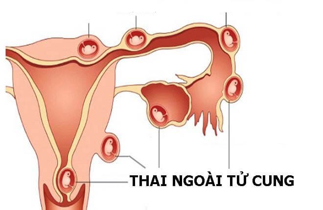 7. Biến Chứng Thai Ngoài Tử Cung