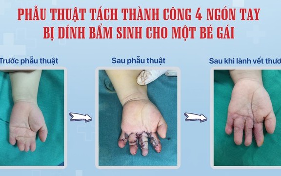 Bệnh viện Sản Nhi Nghệ An phẫu thuật tách thành công 4 ngón tay bị dính bẩm sinh cho trẻ