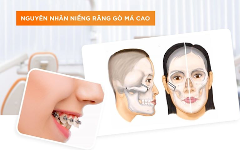 Niềng răng bị hóp má: Nguyên nhân và cách khắc phục hiệu quả- Ảnh 3.