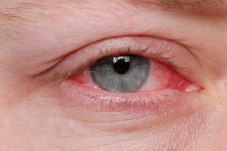 Đâu là thuốc trị đau mắt đỏ an toàn? - Ảnh 2.