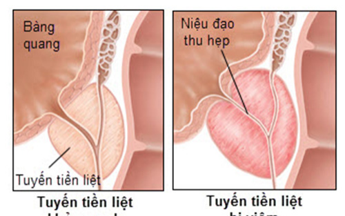 Viêm tuyến tiền liệt có dễ phát hiện không?- Ảnh 2.