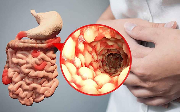 6 cách ngăn chặn sự bùng phát của bệnh Crohn