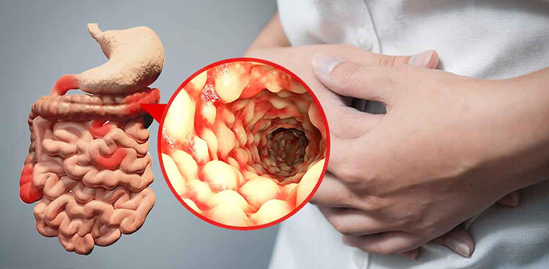 Bệnh Crohn có biểu hiện và những hệ lụy gì? - Ảnh 1.