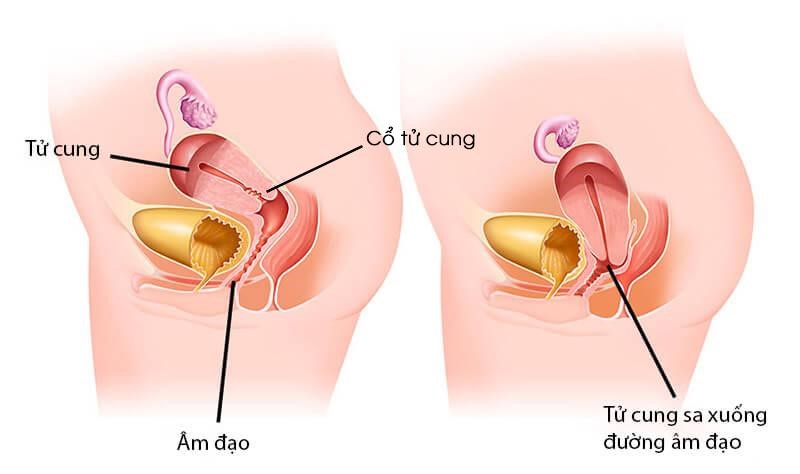 1. Nguyên Nhân Gây Sa Tử Cung