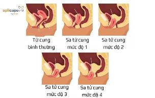 Biến chứng nguy hiểm của sa tử cung